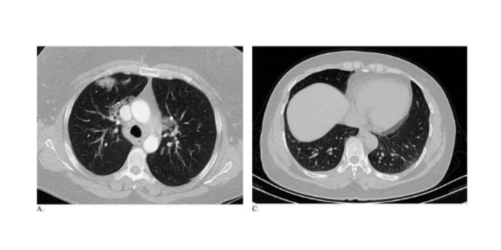 Coronavirus disease 2019 pandemic pneumonia patterns found on CT scan