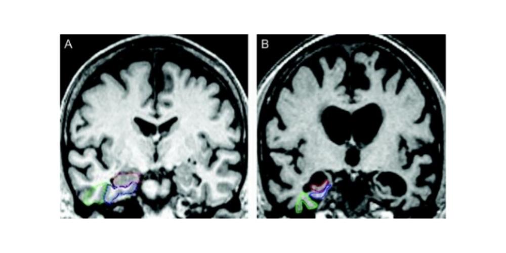 Possible ultrasound treatment for Alzheimer's disease