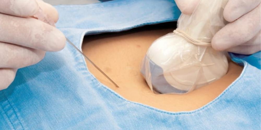 Krystal Ultrasound Probe Covers Reduce Infections and Give Krystal Clear Results