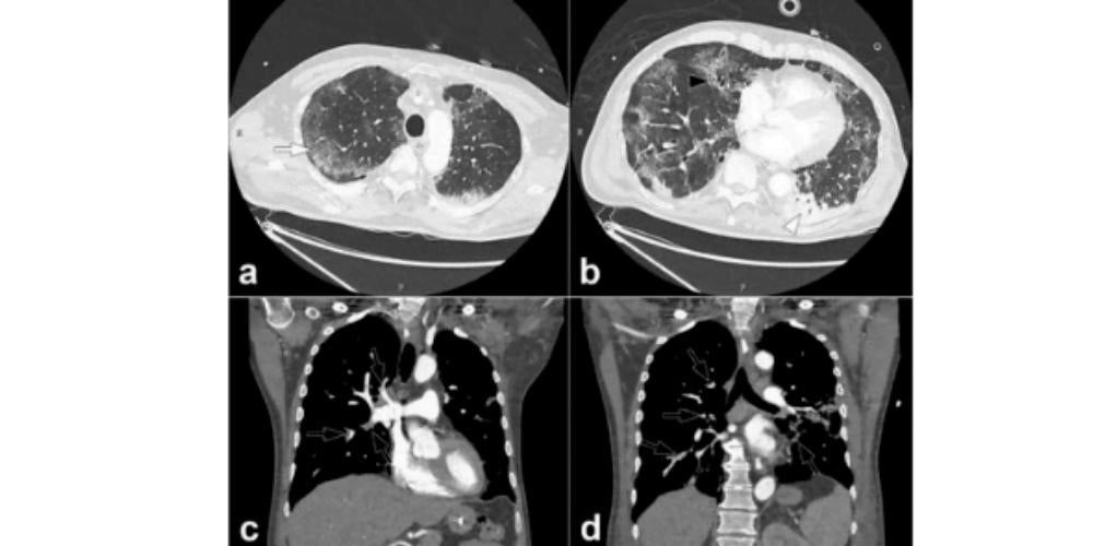 Research finds dangerous blood clots linked to COVID-19