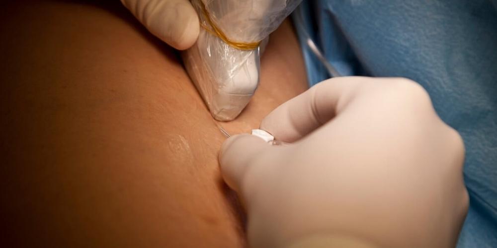 ultrasound probe cover for IV placement