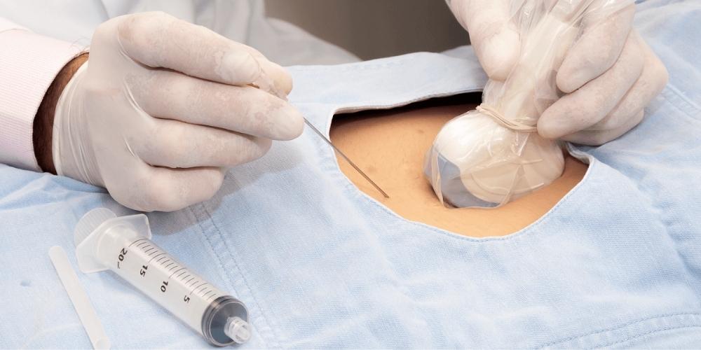 Why should ultrasound be used for vascular access procedures?