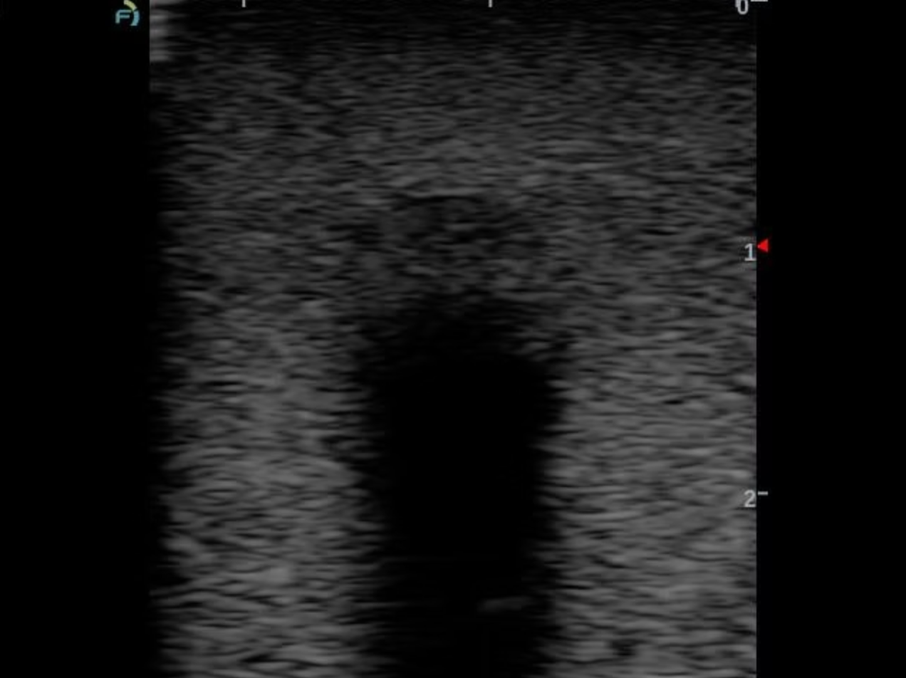 A grayscale ultrasound image showing a dark, irregularly shaped fluid-filled cyst or cavity surrounded by a textured, grainy gray tissue background.