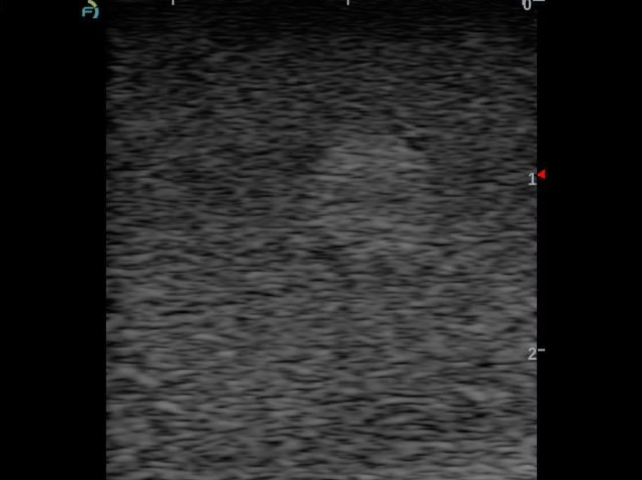 A grayscale ultrasound image showing a textured, speckled pattern with measurement markers on the right side.