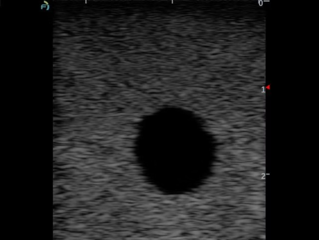 A grayscale ultrasound image showing a single dark, oval-shaped lesion or cyst against a textured, grainy gray background.