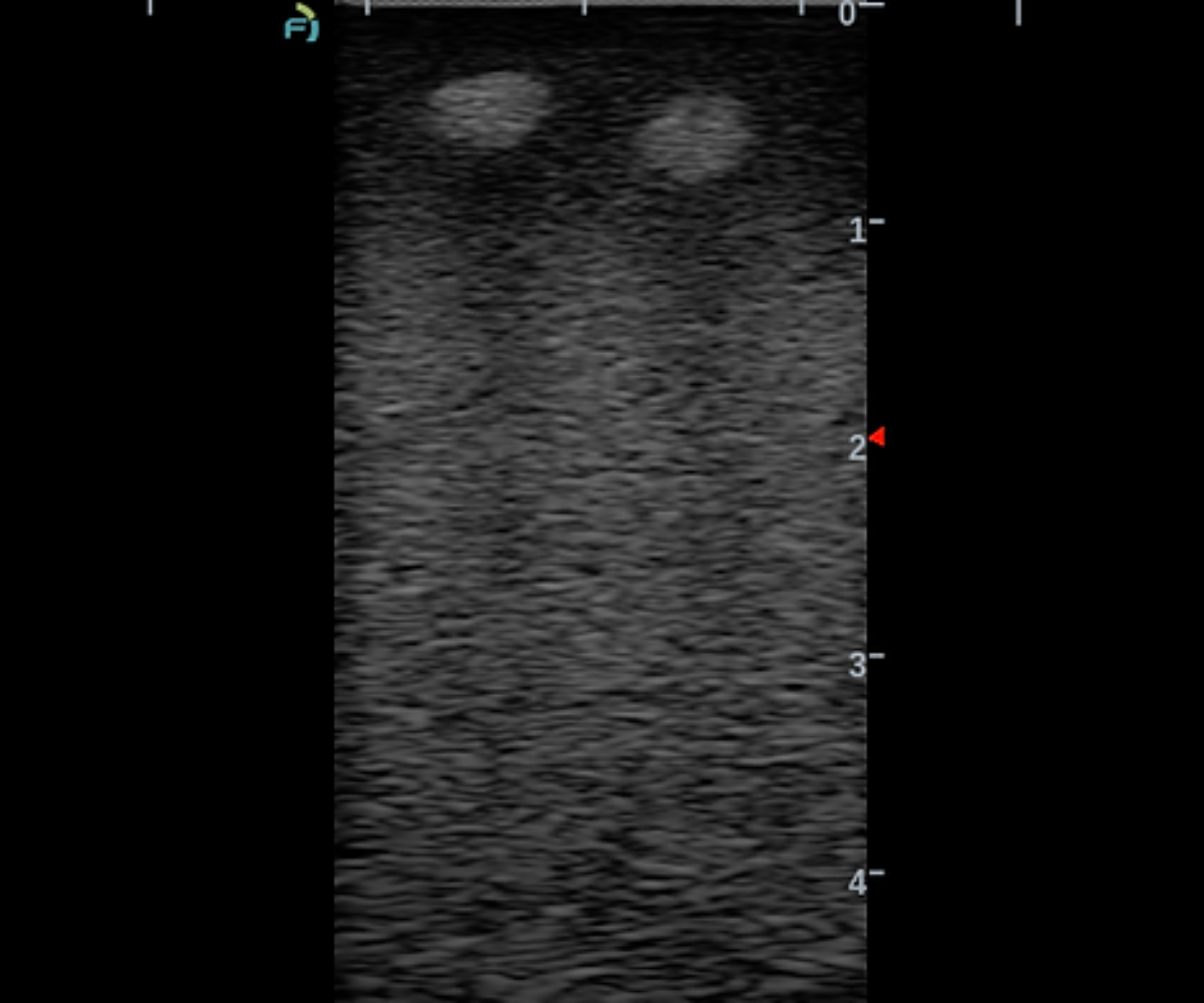 Another ultrasound image of the face training phantom