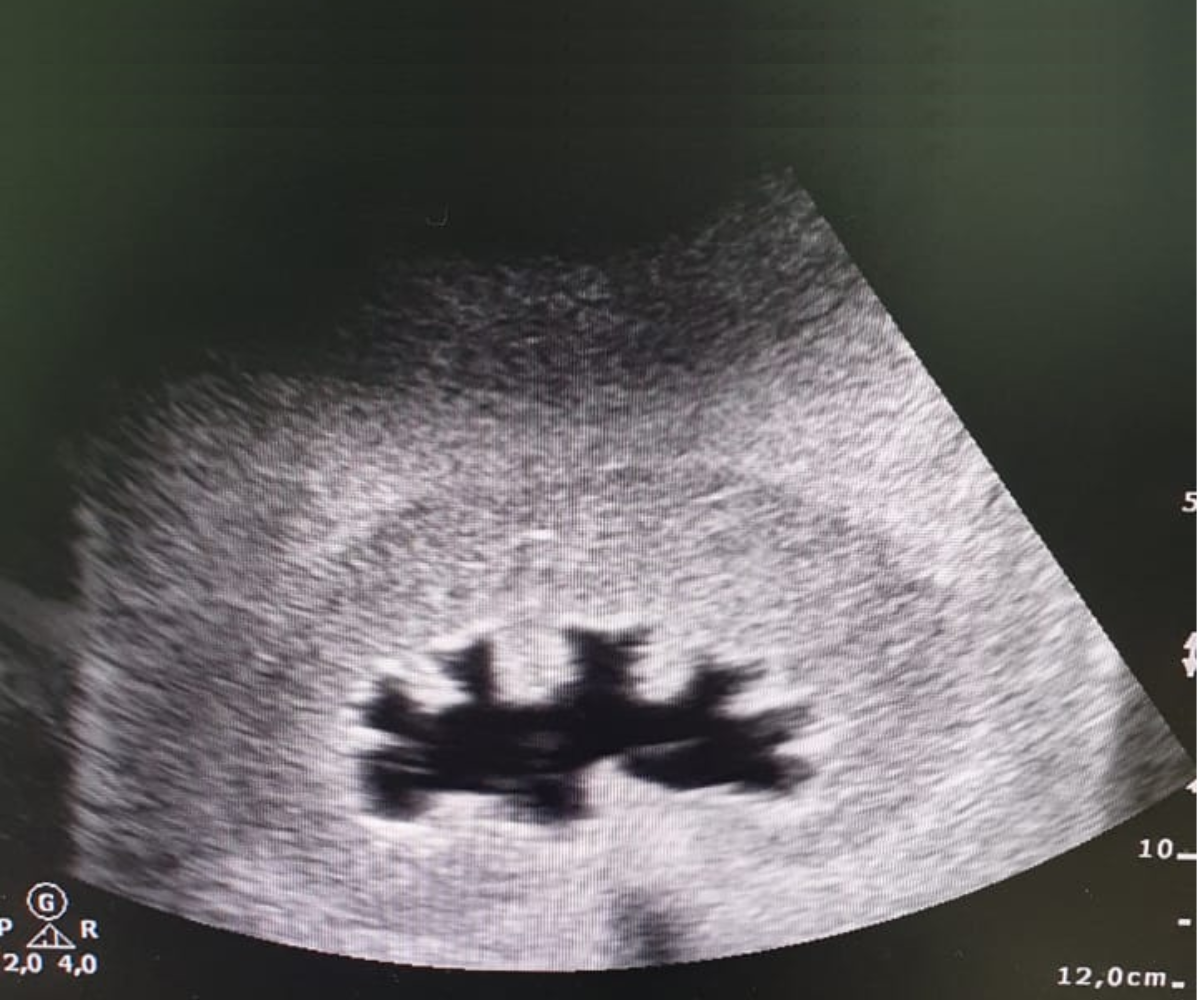 Kidney Training Phantom