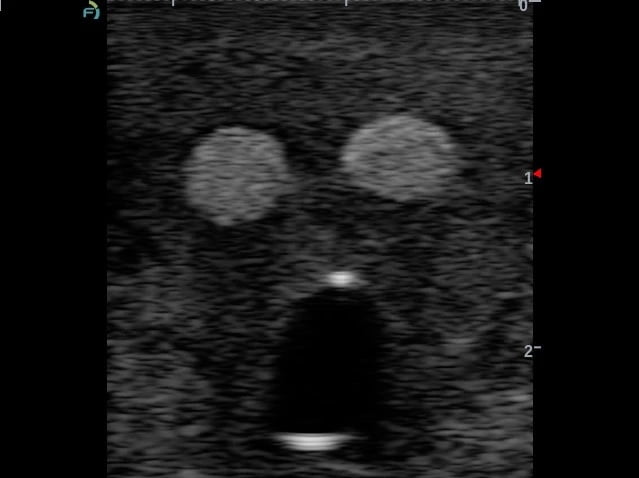 Anesthesia Phantom with Nerves