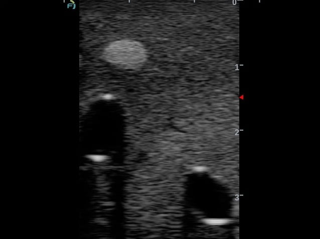 Anesthesia Phantom with Veins