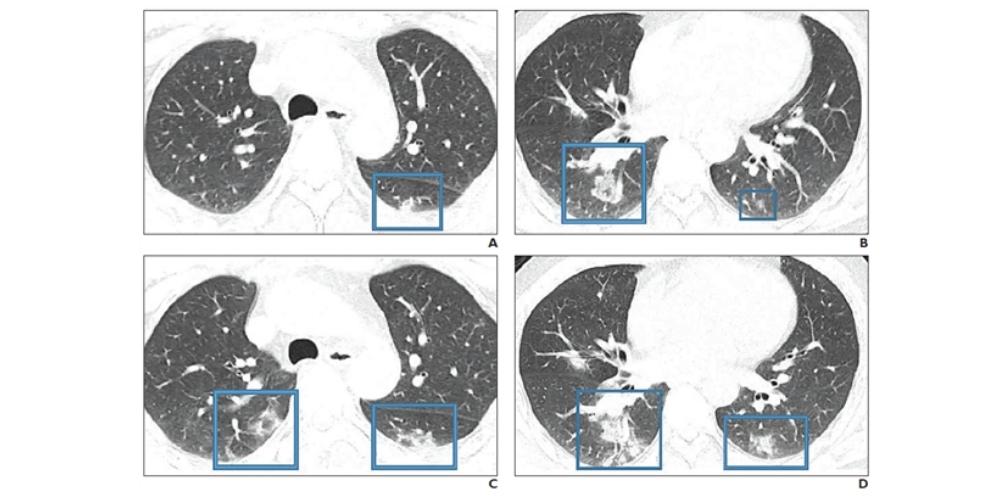 Medical imaging showing lungs infected with novel coronavirus 2019 (COVID-19)