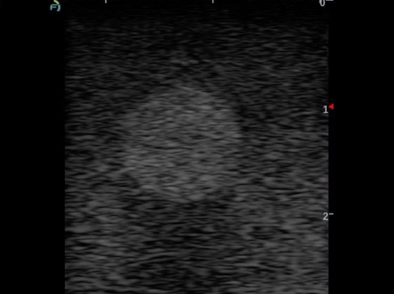 A grayscale ultrasound image showing a circular, hypoechoic mass or lesion against a textured, grainy background with measurement markers on the right side.