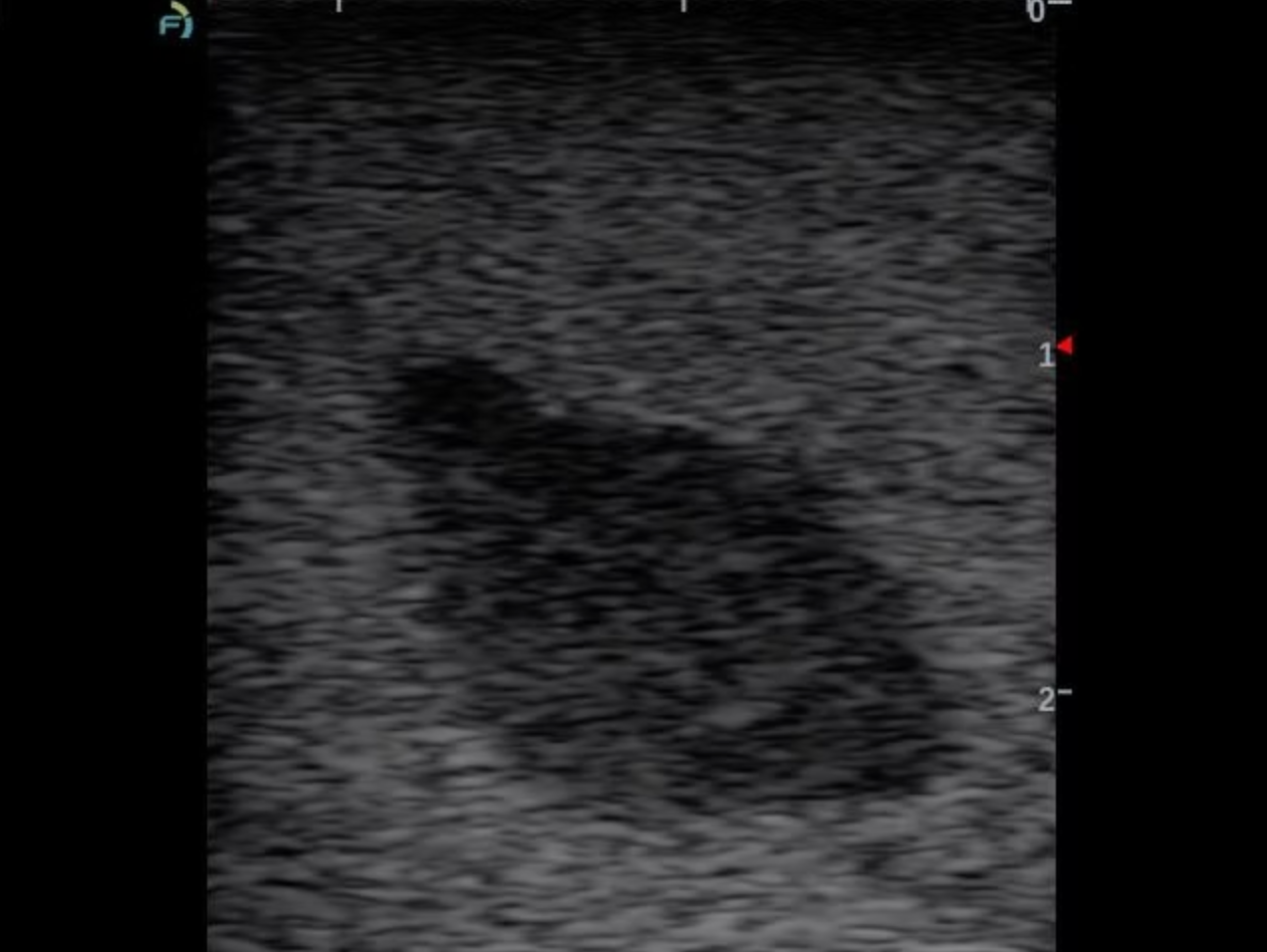 A grayscale ultrasound image showing a dark, irregularly shaped fluid-filled cyst or lesion against a grainy, textured gray background with measurement markers on the right side.