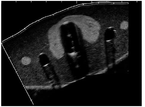 Ultrasound images of thyroid biopsy training phantom